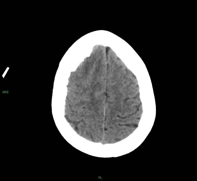 File:Cerebral amyloid angiopathy-associated lobar intracerebral hemorrhage (Radiopaedia 58569-65734 Axial non-contrast 18).jpg