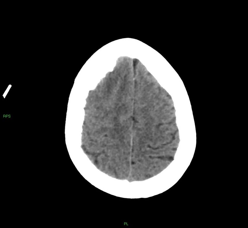 Cerebral amyloid angiopathy-associated lobar intracerebral hemorrhage (Radiopaedia 58569-65734 Axial non-contrast 18).jpg
