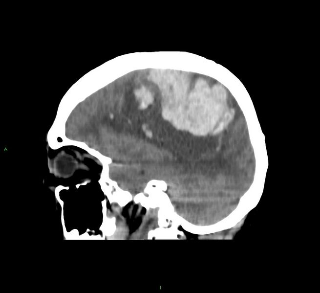 File:Cerebral amyloid angiopathy-associated lobar intracerebral hemorrhage (Radiopaedia 58751-65972 C 20).jpg