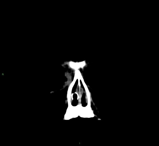 File:Cerebral amyloid angiopathy-associated lobar intracerebral hemorrhage (Radiopaedia 58751-65972 Coronal non-contrast 60).jpg