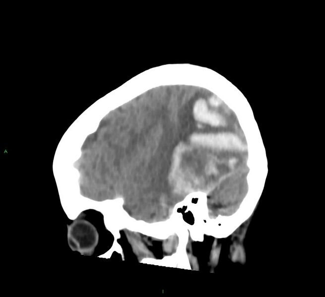 File:Cerebral amyloid angiopathy-associated lobar intracerebral hemorrhage (Radiopaedia 58754-65975 C 38).jpg