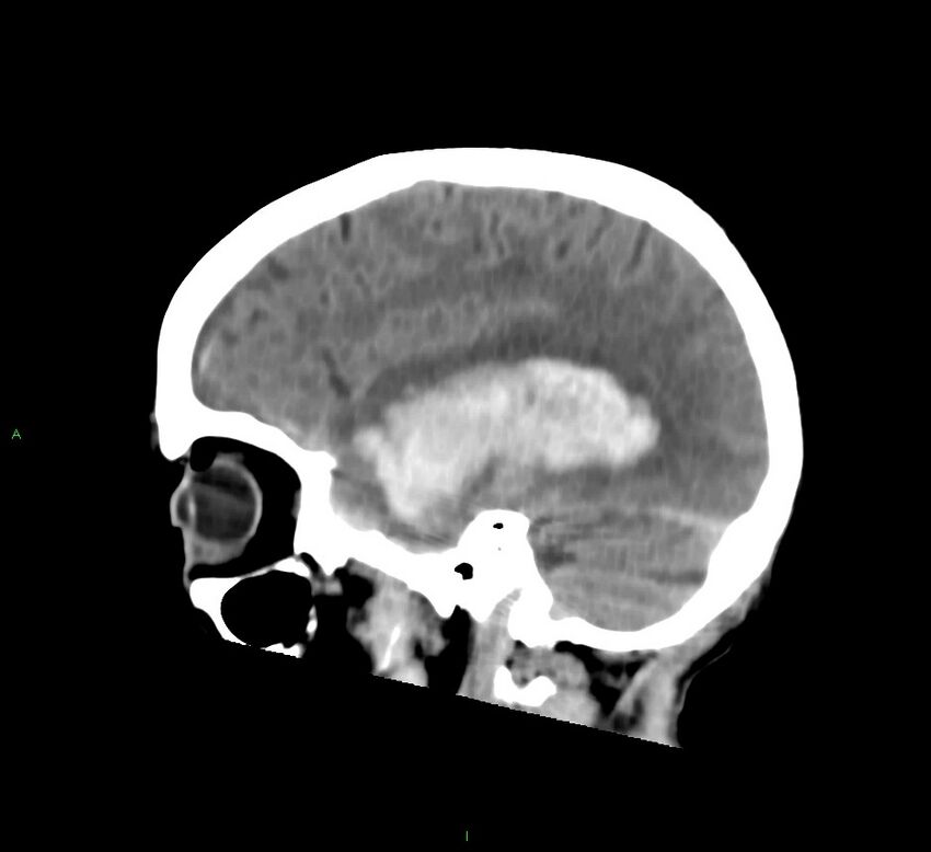 Cerebral amyloid angiopathy-associated lobar intracerebral hemorrhage (Radiopaedia 58758-65980 C 17).jpg