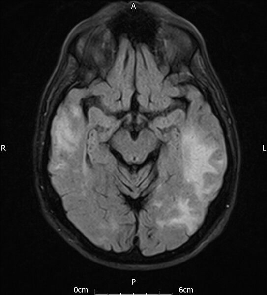 File:Cerebral amyloid angiopathy related inflammation (Radiopaedia 72772-83415 Axial FLAIR 10).jpg