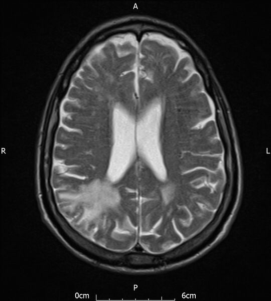 File:Cerebral amyloid angiopathy related inflammation (Radiopaedia 72772-83415 Axial T2 15).jpg