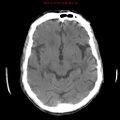 Cerebral and orbital tuberculomas (Radiopaedia 13308-13310 Axial non-contrast 12).jpg