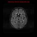 Cerebral and orbital tuberculomas (Radiopaedia 13308-13311 Axial FLAIR 11).jpg