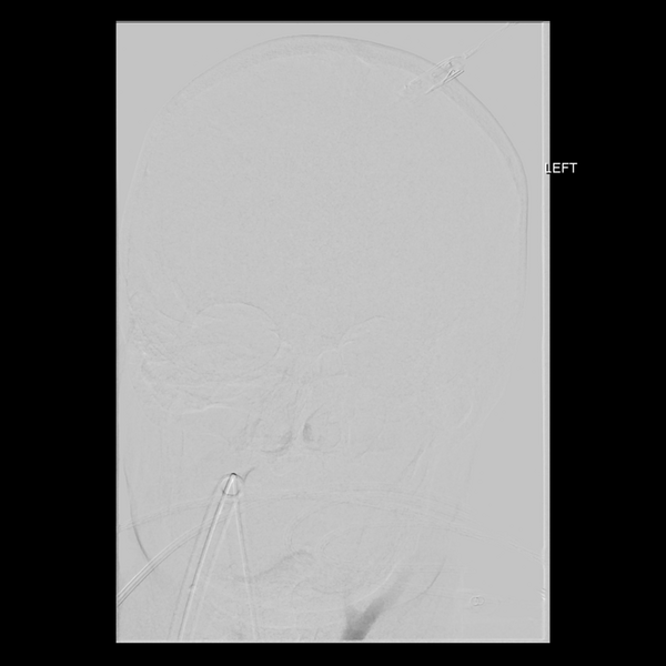 File:Cerebral arteriovenous malformation with lobar hemorrhage (Radiopaedia 44725-48513 LT CCA IC 6).png