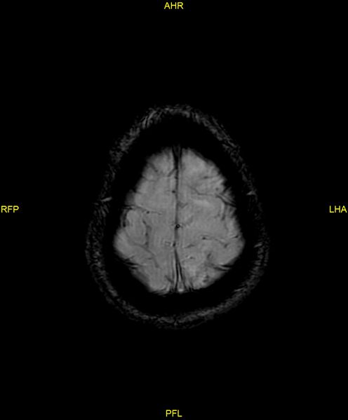 File:Cerebral autosomal dominant arteriopathy with subcortical infarcts and leukoencephalopathy (CADASIL) (Radiopaedia 86108-102054 Axial SWI 96).jpg