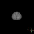 Cerebral contusion (Radiopaedia 48869-53911 Axial bone window 1).jpg