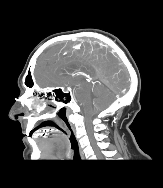 File:Cerebral dural venous sinus thrombosis (Radiopaedia 86514-102576 C 27).jpg
