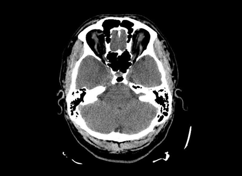 File:Cerebral edema (Radiopaedia 82519-96661 Axial non-contrast 42).jpg