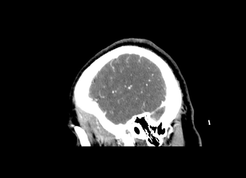 Cerebral edema (Radiopaedia 82519-96661 D 45).jpg