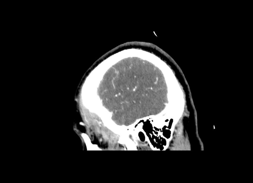 Cerebral edema (Radiopaedia 82519-96661 D 46).jpg