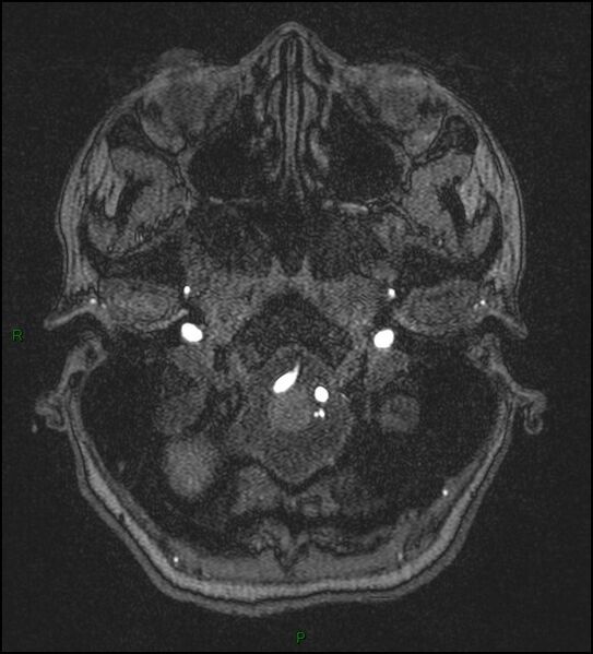File:Cerebral fat embolism (Radiopaedia 35022-36525 Axial TOF 18).jpg