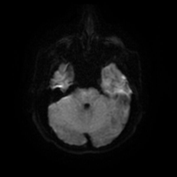 File:Cerebral fat embolism (Radiopaedia 37510-39363 Axial DWI 9).jpg