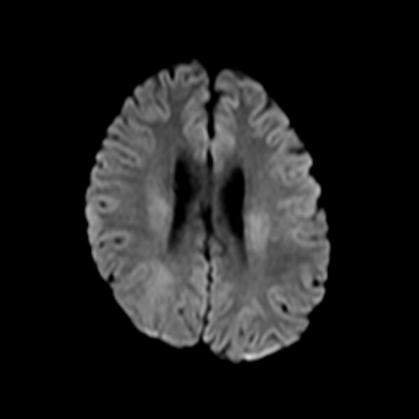 File:Cerebral tuberculoma (Radiopaedia 41152-43932 Axial DWI 15).jpg