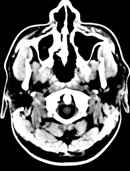 File:Cerebral venous angioma (Radiopaedia 69959-79977 Axial non-contrast 3).jpg