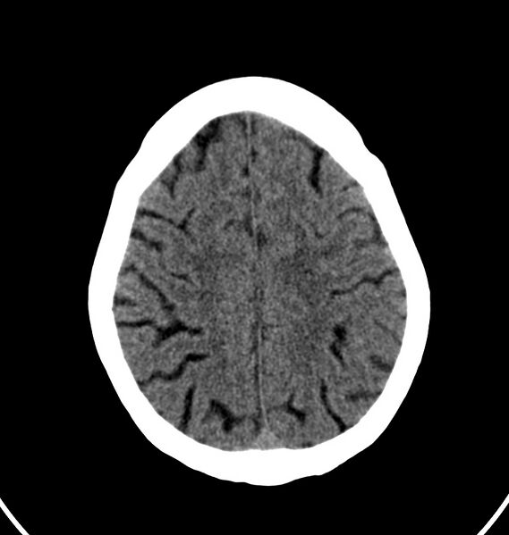 File:Cerebral venous thrombosis - CT only (Radiopaedia 41031-43778 Axial non-contrast 17).jpg