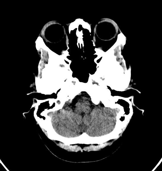 File:Cerebral venous thrombosis - CT only (Radiopaedia 41031-43778 Axial non-contrast 72).jpg