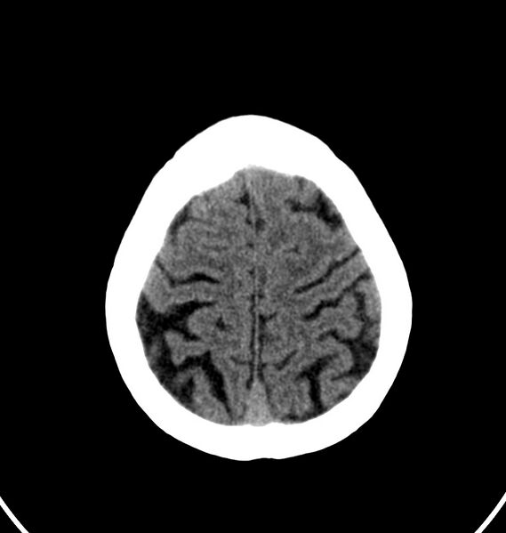 File:Cerebral venous thrombosis - CT only (Radiopaedia 41031-43778 Axial non-contrast 9).jpg