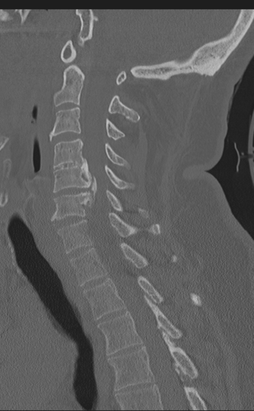 File:Cervical canal stenosis - OPLL and osteophytes (Radiopaedia 47329-51910 Sagittal bone window 41).png