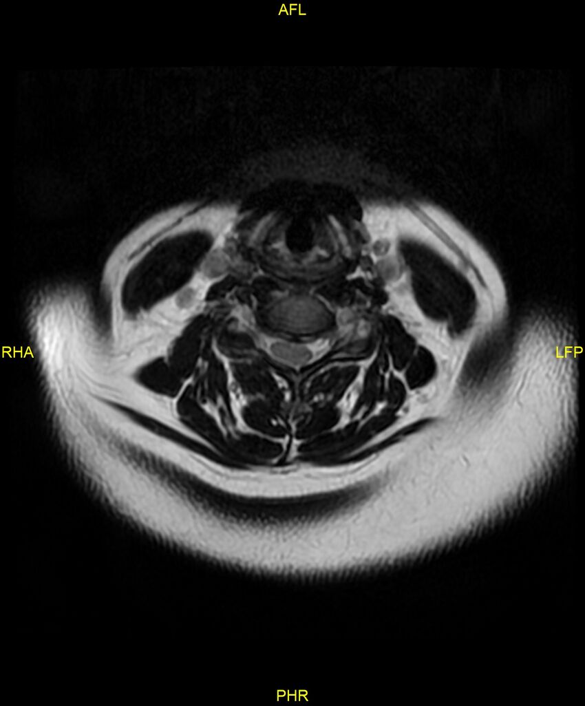 Cervical disc protrusion (Radiopaedia 87147-103415 Axial T2 19).jpg