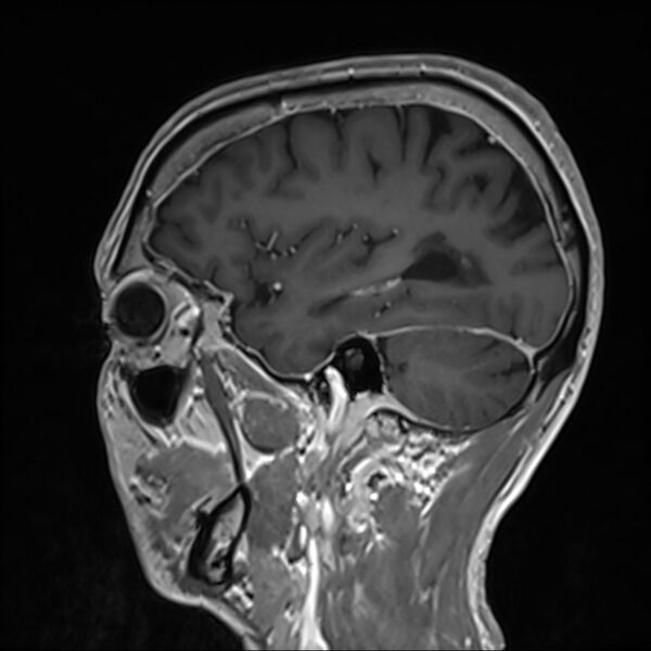 File:Cervical dural CSF leak on MRI and CT treated by blood patch (Radiopaedia 49748-54995 G 88).jpg