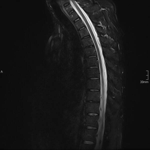 File:Cervical dural CSF leak on MRI and CT treated by blood patch (Radiopaedia 49748-54995 Sagittal STIR 1).jpg