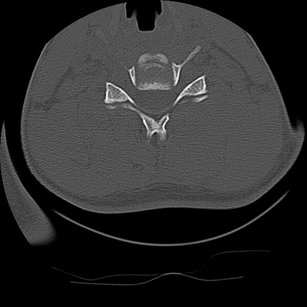 File:Cervical flexion teardrop fracture with cord hemorrhage (Radiopaedia 32497-33454 Axial bone window 55).jpg