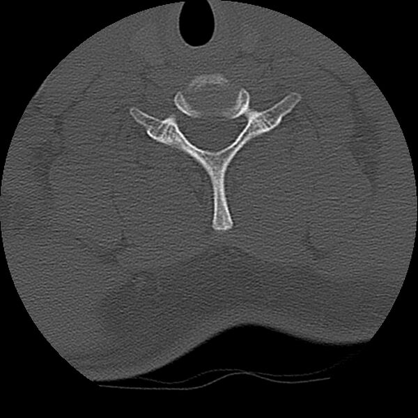 File:Cervical flexion teardrop fracture with cord hemorrhage (Radiopaedia 32497-33454 Axial bone window 64).jpg