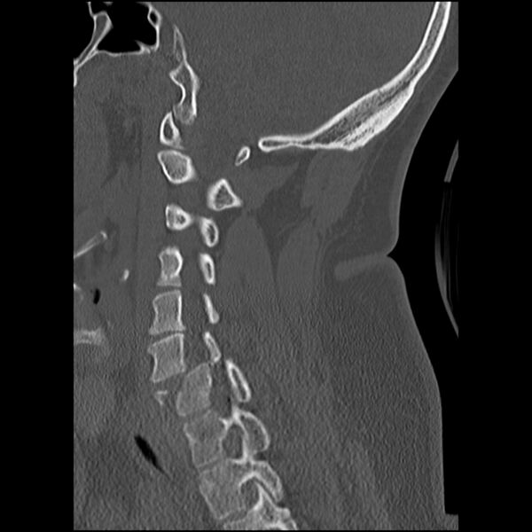 File:Cervical fracture and dislocation with locked facet (Radiopaedia 31837-32780 Sagittal bone window 22).jpg