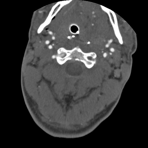File:Cervical spine fractures with vertebral artery dissection (Radiopaedia 32135-33078 D 61).jpg