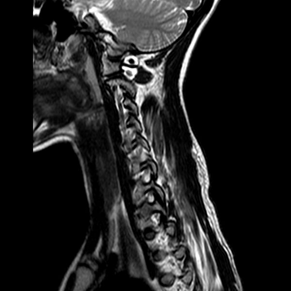 File:Cervical spine posterior ligamentous complex rupture (Radiopaedia 63486-72103 Sagittal T2 2).jpg