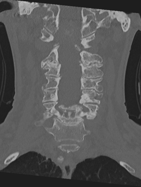 File:Cervical spondylolysis (Radiopaedia 49616-54811 Coronal bone window 23).png