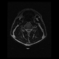 Cervical vertebrae metastasis (Radiopaedia 78814-91667 Axial T2 12).png