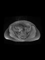 Cesarean section scar endometrioma (Radiopaedia 56569-63297 Axial PD fat sat 15).jpg