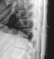 Chance fracture (Radiopaedia 36521-38080 Lateral 1).png