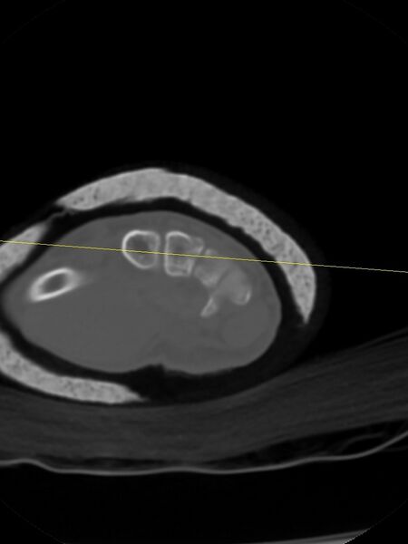 File:Chauffeur's (Hutchinson) fracture (Radiopaedia 58043-65079 Axial bone window 4).jpg