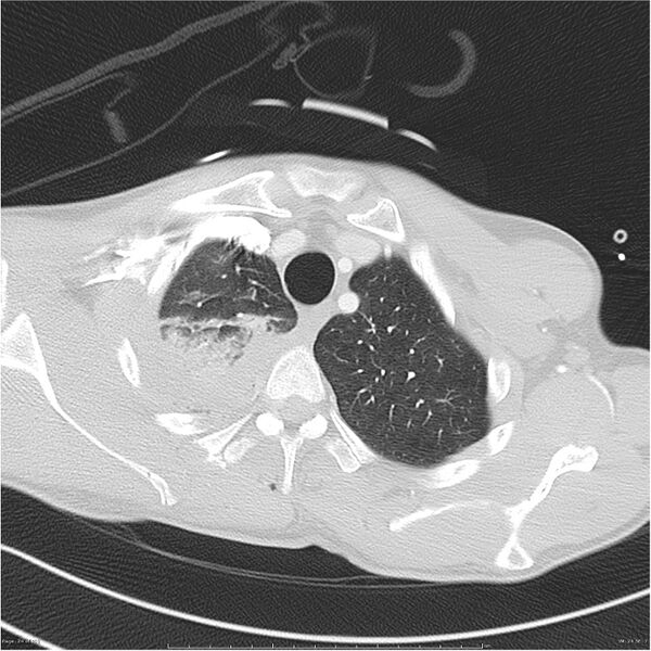 File:Chest and abdomen multi-trauma (Radiopaedia 26294-26425 lung window 24).jpg