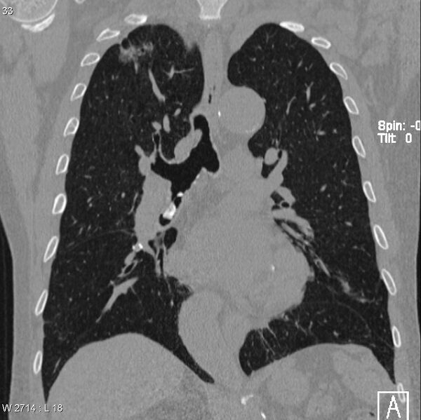 File:Chicken bone in bronchus (Radiopaedia 6550-7861 Coronal lung window 1).jpg