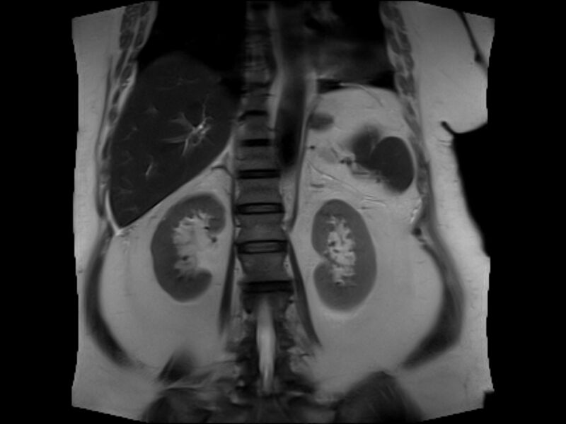File:Choledocholithiasis causing intrahepatic biliary duct dilation (Radiopaedia 39908-42369 Coronal T2 18).jpg