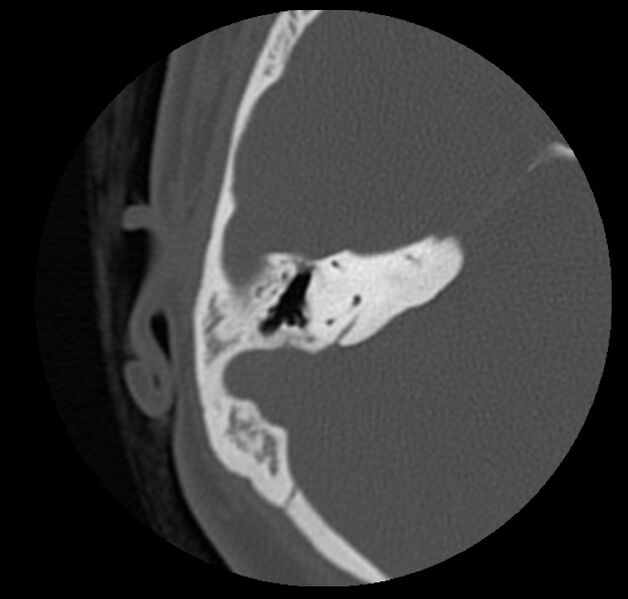 File:Cholesteatoma (Radiopaedia 20296-20217 bone window 32).jpg