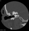 Cholesteatoma (Radiopaedia 5467-7197 Coronal bone window 14).jpg