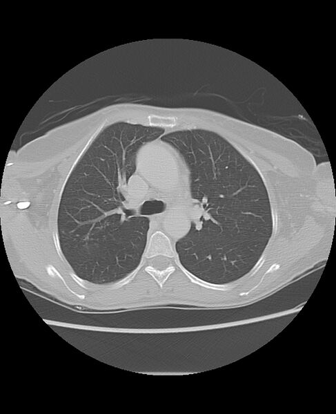 File:Chondrosarcoma (Radiopaedia 79427-92532 Axial lung window 21).jpg