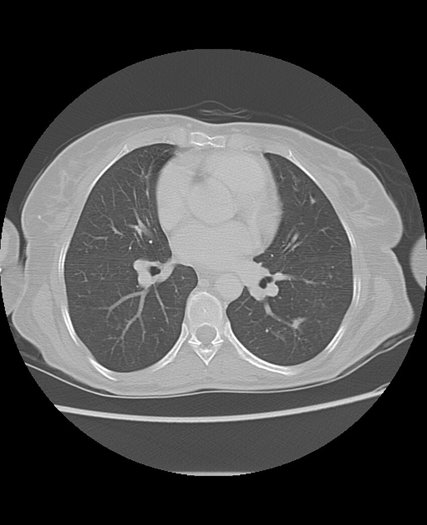 Chondrosarcoma (Radiopaedia 79427-92532 Axial lung window 31).jpg