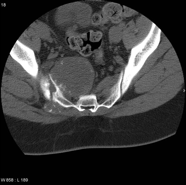 File:Chondrosarcoma - sacrum (Radiopaedia 6173-43874 Axial bone window 1).jpg