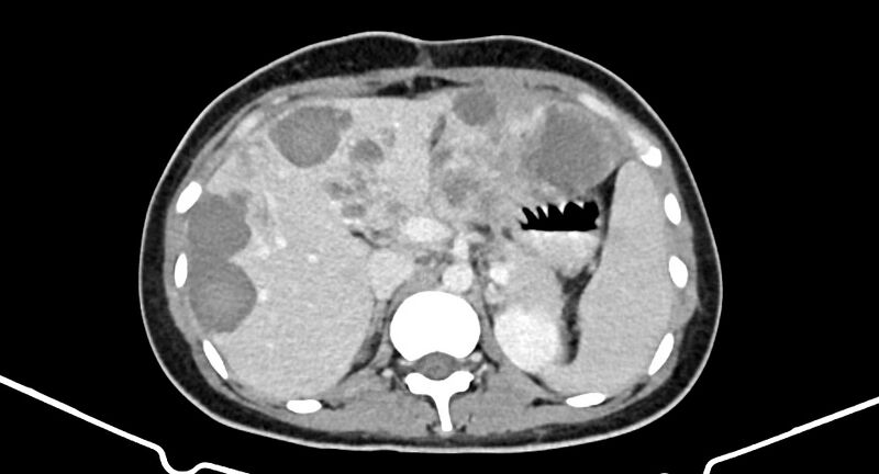 File:Choriocarcinoma liver metastases (Radiopaedia 74768-85766 A 72).jpg