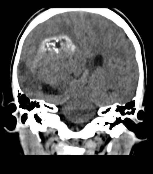 File:Choroid plexus carcinoma (Radiopaedia 91013-108552 Coronal non-contrast 51).jpg