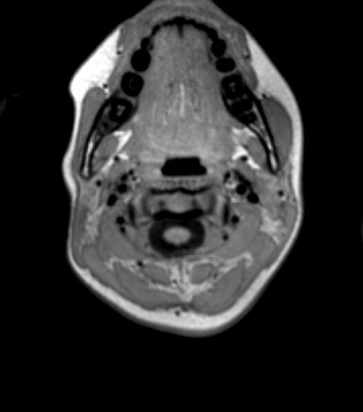 File:Choroid plexus carcinoma (Radiopaedia 91013-108553 Axial T1 5).jpg