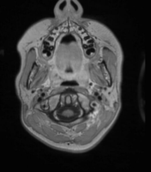 File:Choroid plexus carcinoma (Radiopaedia 91013-108553 Axial T1 C+ 58).jpg